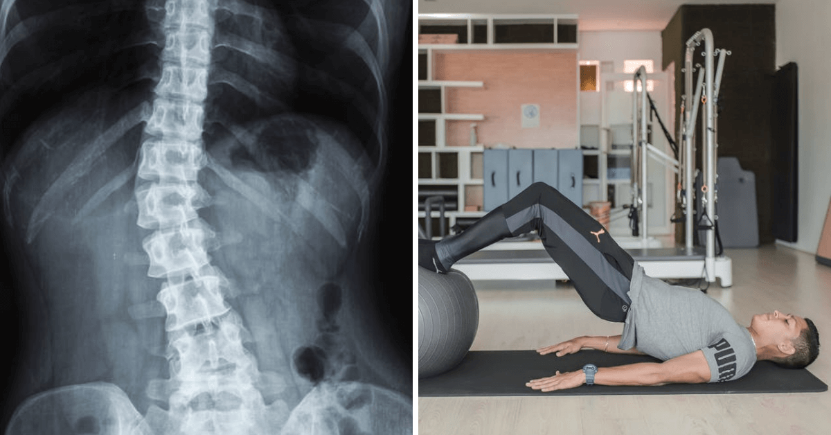 Here Are the Best Exercises That People with Scoliosis Can Do